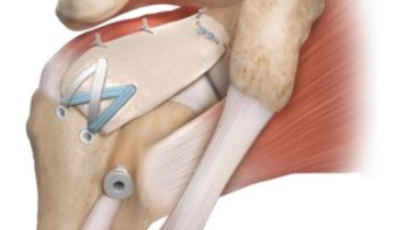 Edukační seminář věnovaný moderní léčbě ramenního kloubu